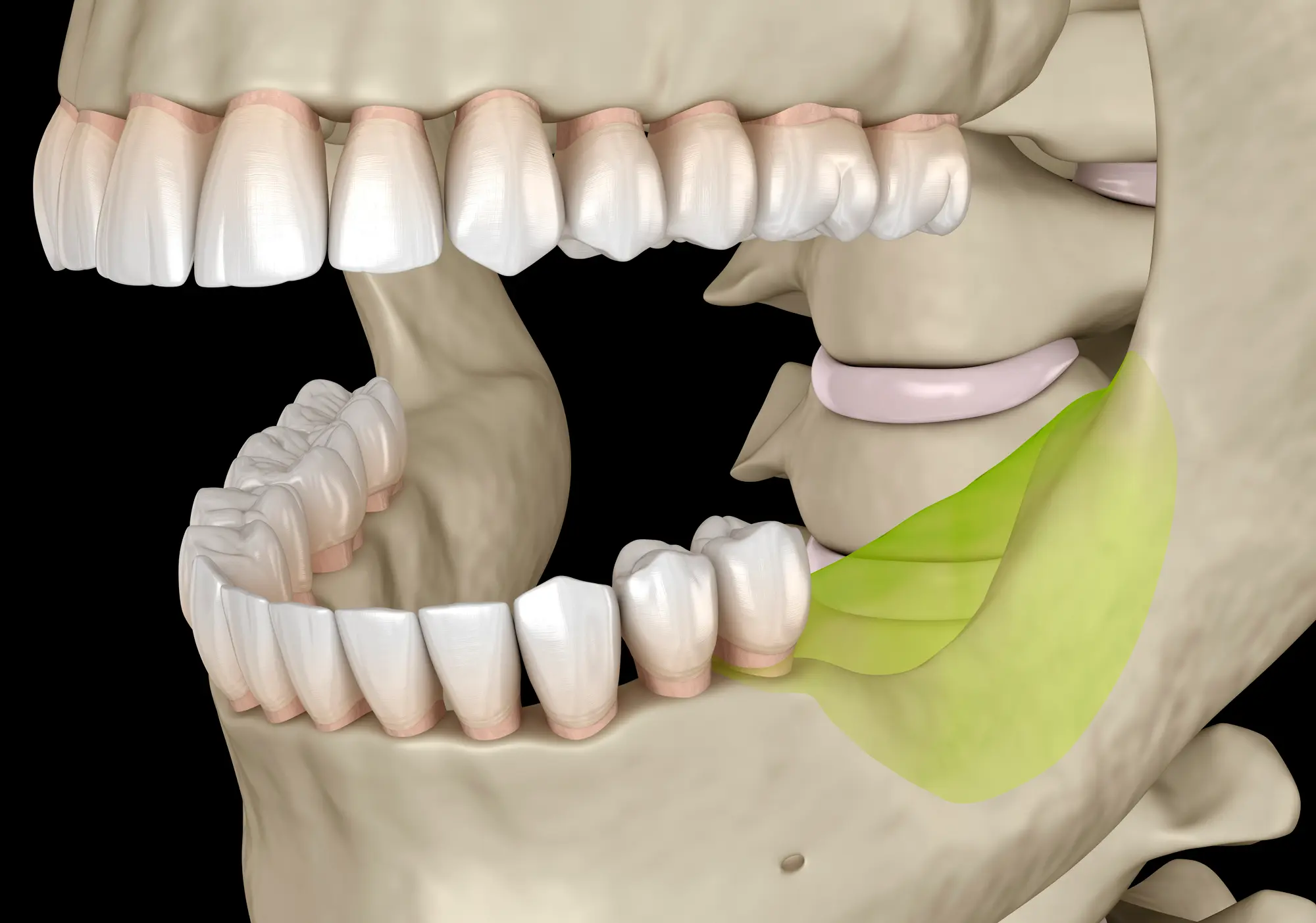 3D medical illustration of the lower jaw showing teeth and a highlighted mandibular nerve path in green.