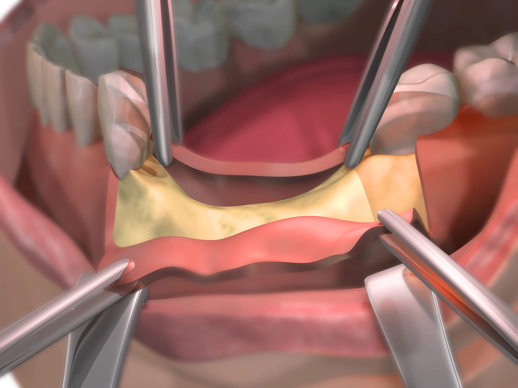 3D illustration of oral surgery showing gum tissue being lifted with surgical instruments to expose jawbone and teeth.
