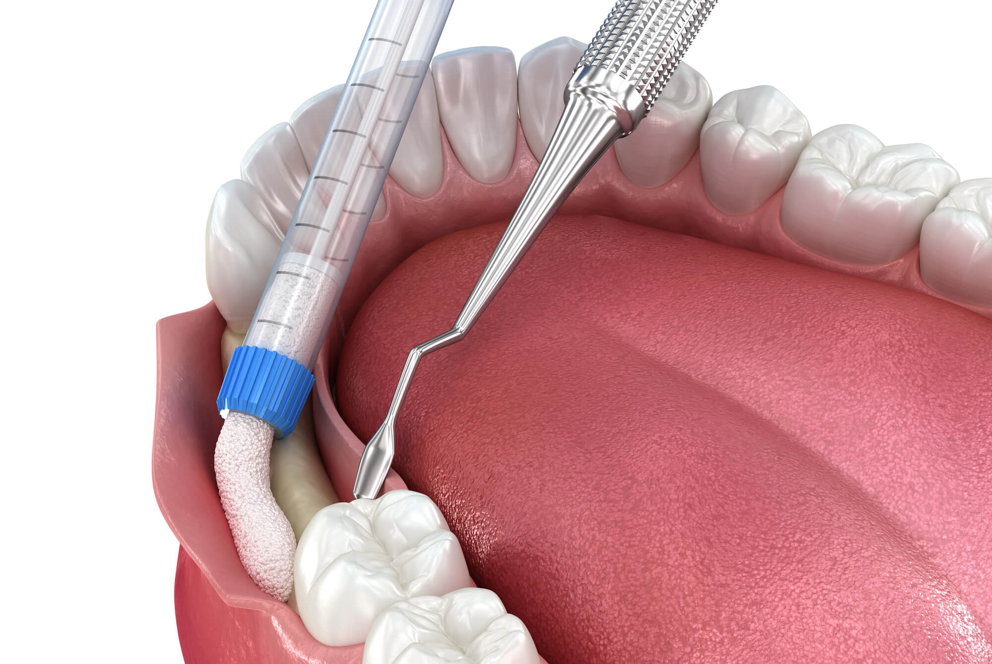 Dental procedure illustration showing bone graft material being applied to jawbone near molars with a dental instrument inside the mouth.