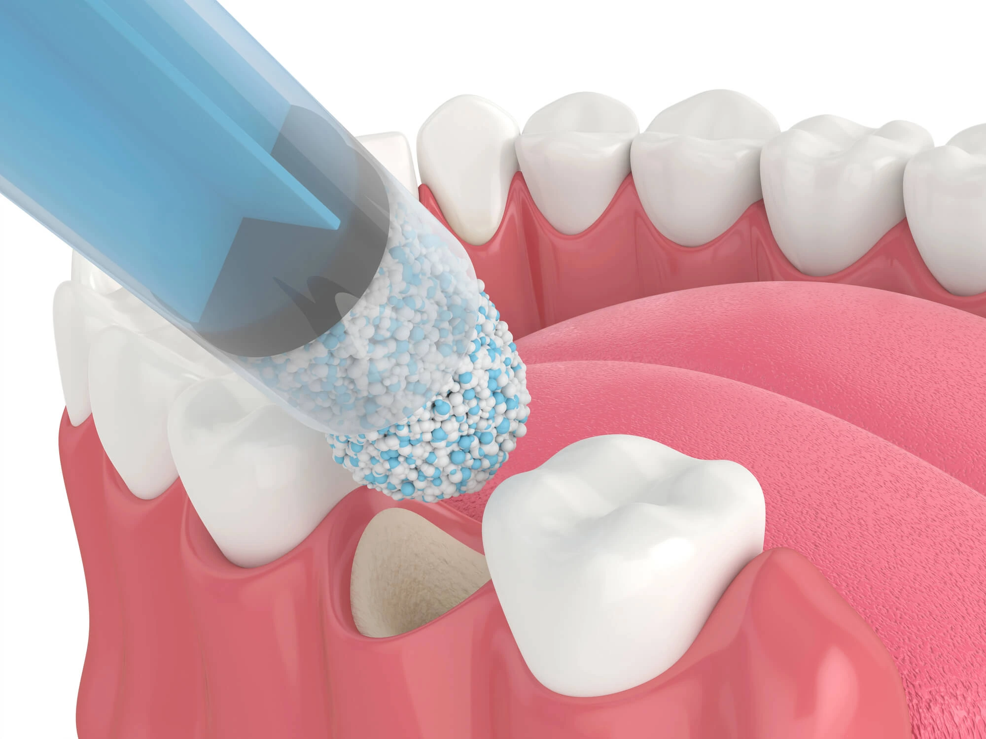 3D illustration of dental bone graft granules being applied to a jawbone socket after tooth extraction.