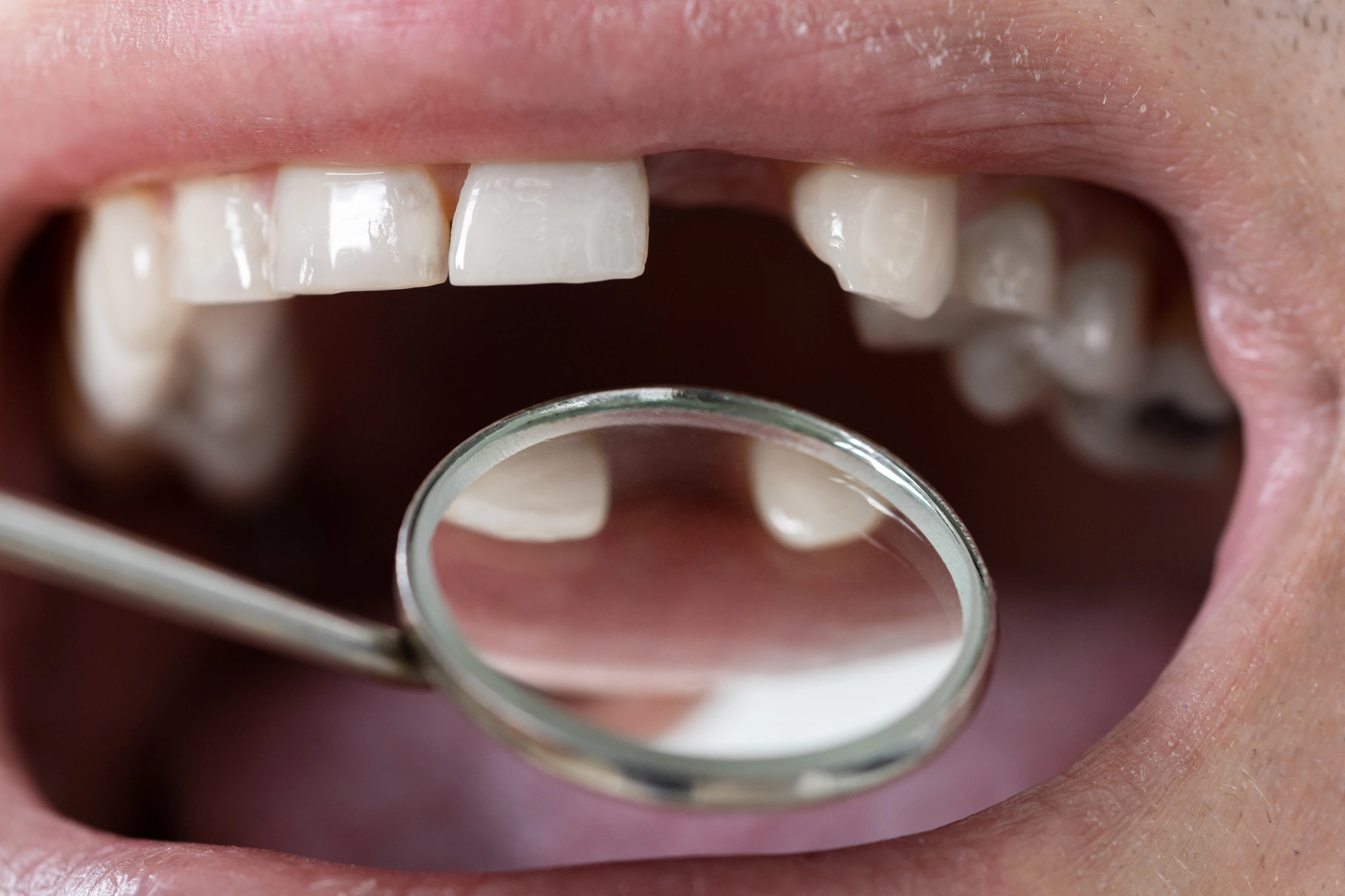 Close-up of an open mouth with a dental mirror reflecting back teeth missing a front tooth.