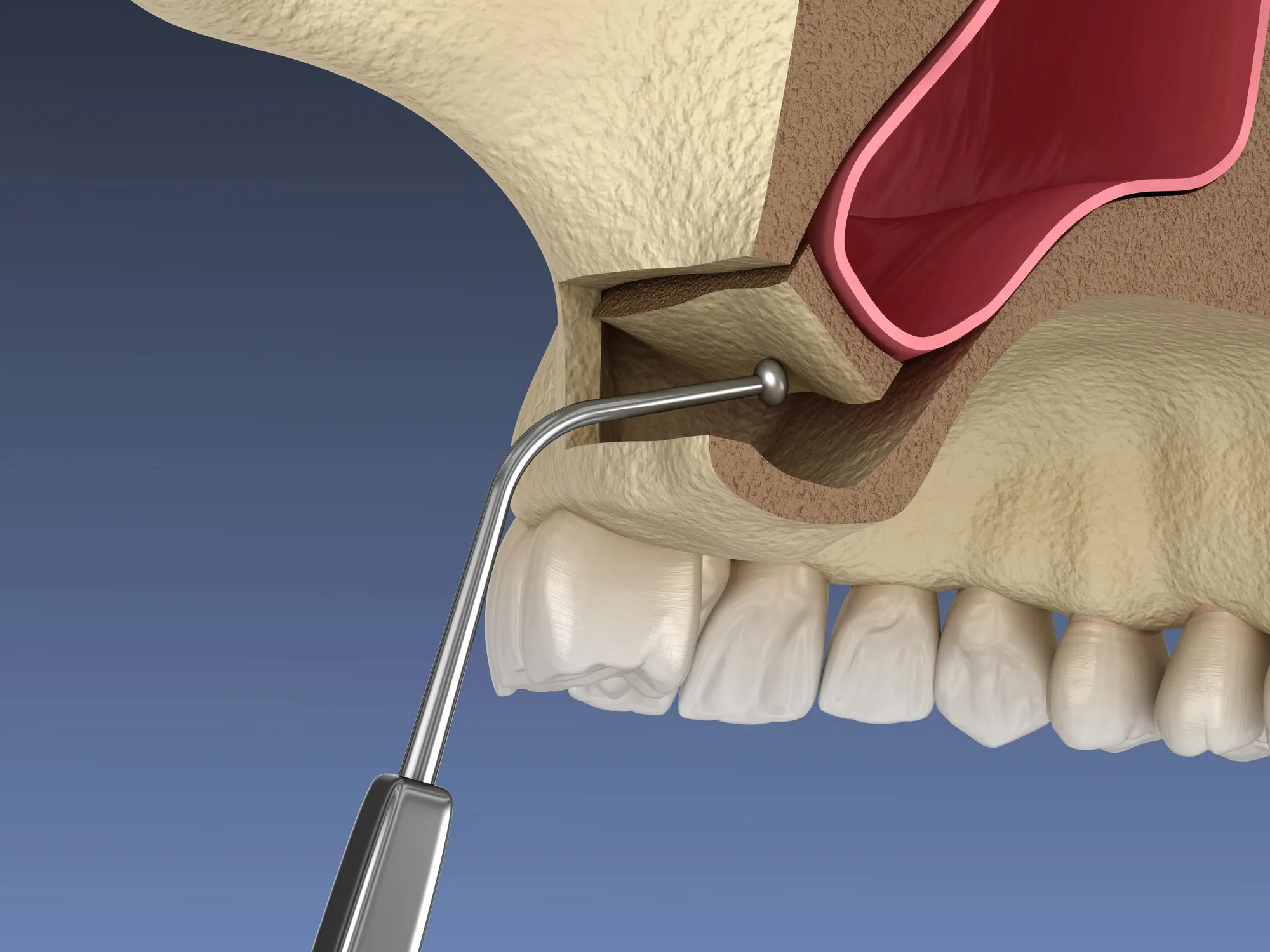 3D illustration of dental implant surgery showing a metal screw being inserted into the upper jawbone above the teeth.