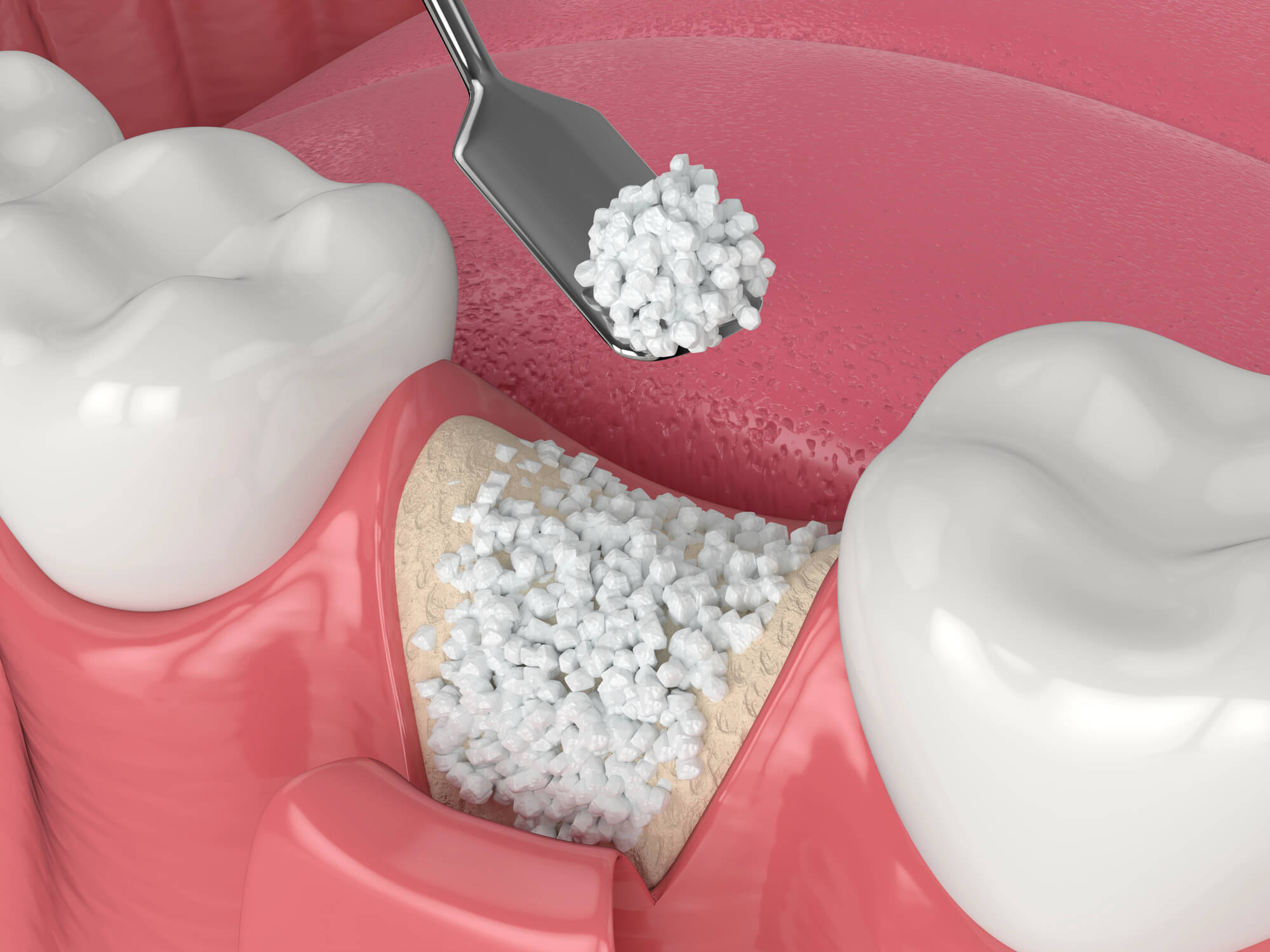 Dental bone graft procedure illustrating granular bone graft material being placed in gum area between teeth.