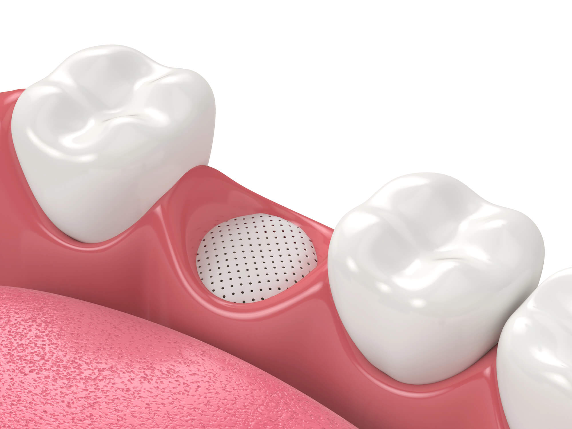 3D illustration of a dental bone graft material placed in the gum where a tooth is missing between two healthy molars.