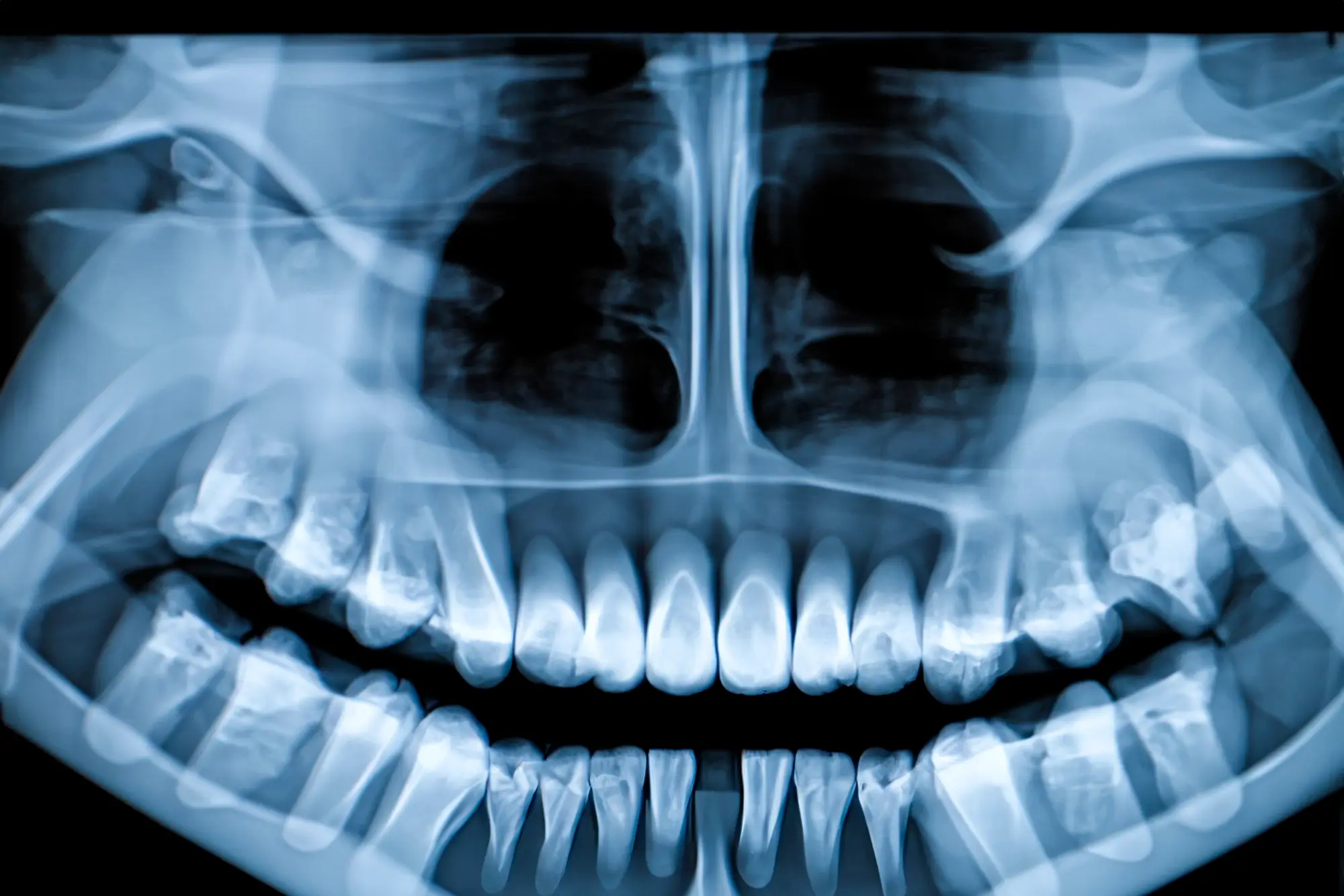 Panoramic dental X-ray showing full set of upper and lower teeth and jawbone structure.