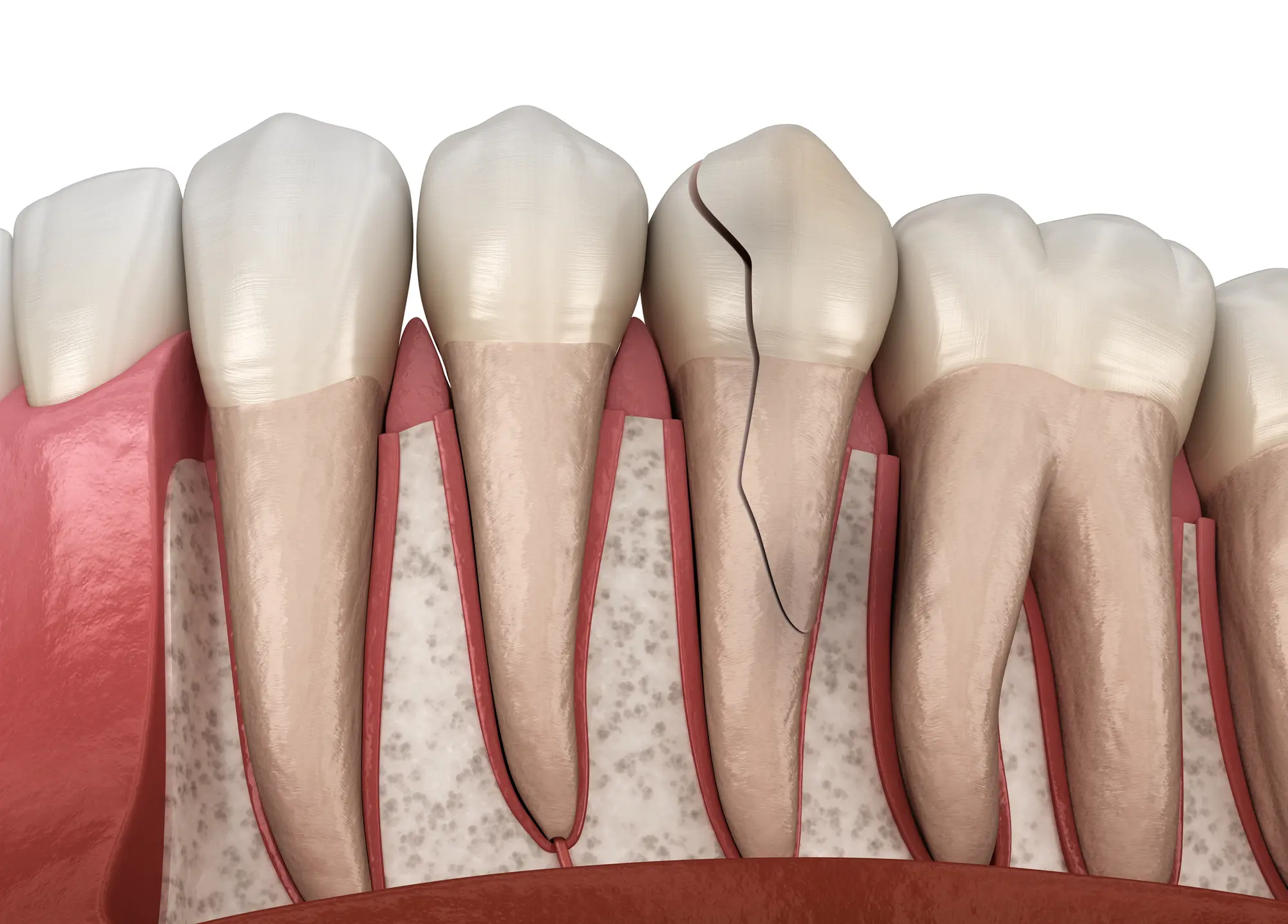 Cross-sectional illustration of human teeth and gums showing a cracked molar tooth beneath the gum line.