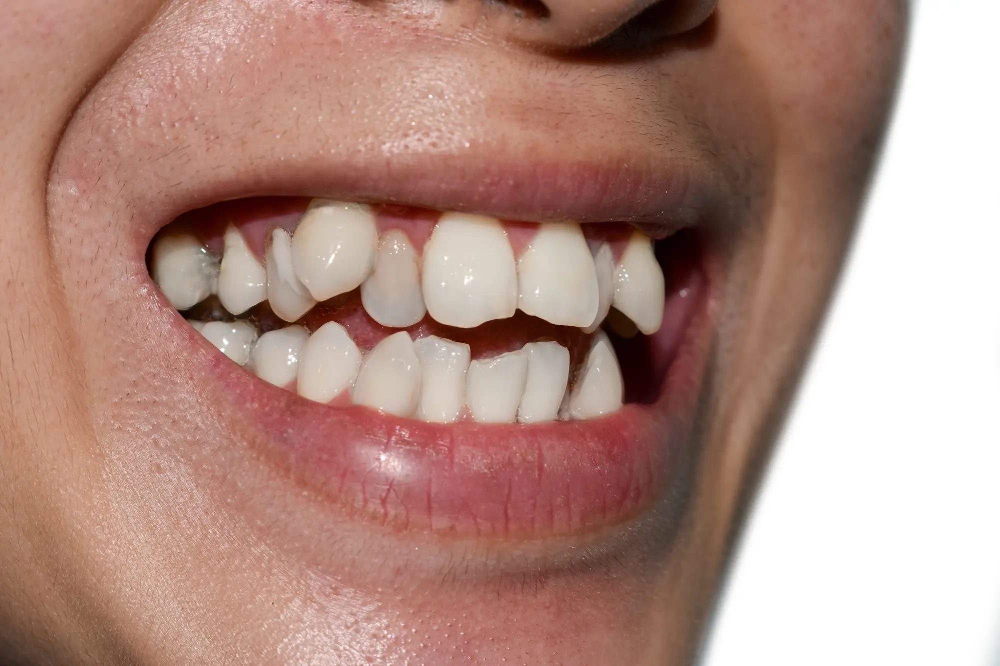 Close-up of a person's mouth showing misaligned and crooked teeth with gaps.