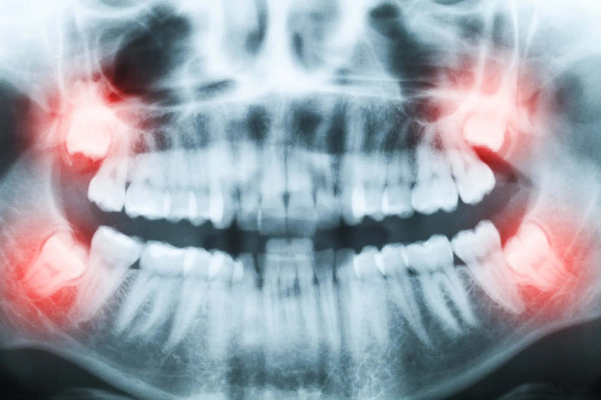 Panoramic dental X-ray showing all teeth with red highlights on impacted wisdom teeth.