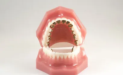 Dental model showing lingual braces on the back of the upper teeth