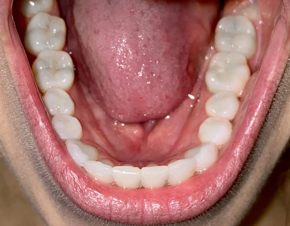 Close-up of a straightened lower arch of teeth after orthodontic treatment.