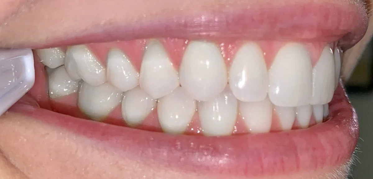 Side view of an aligned bite after orthodontic treatment.
