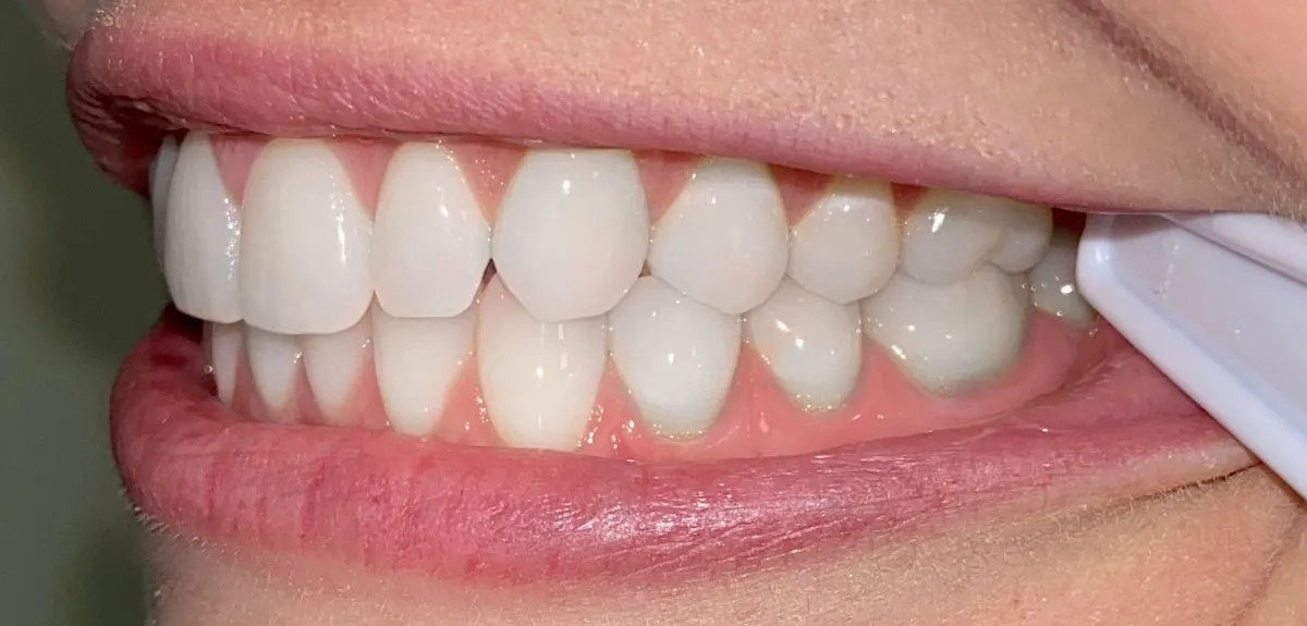 Side view of straight white teeth after orthodontic treatment.