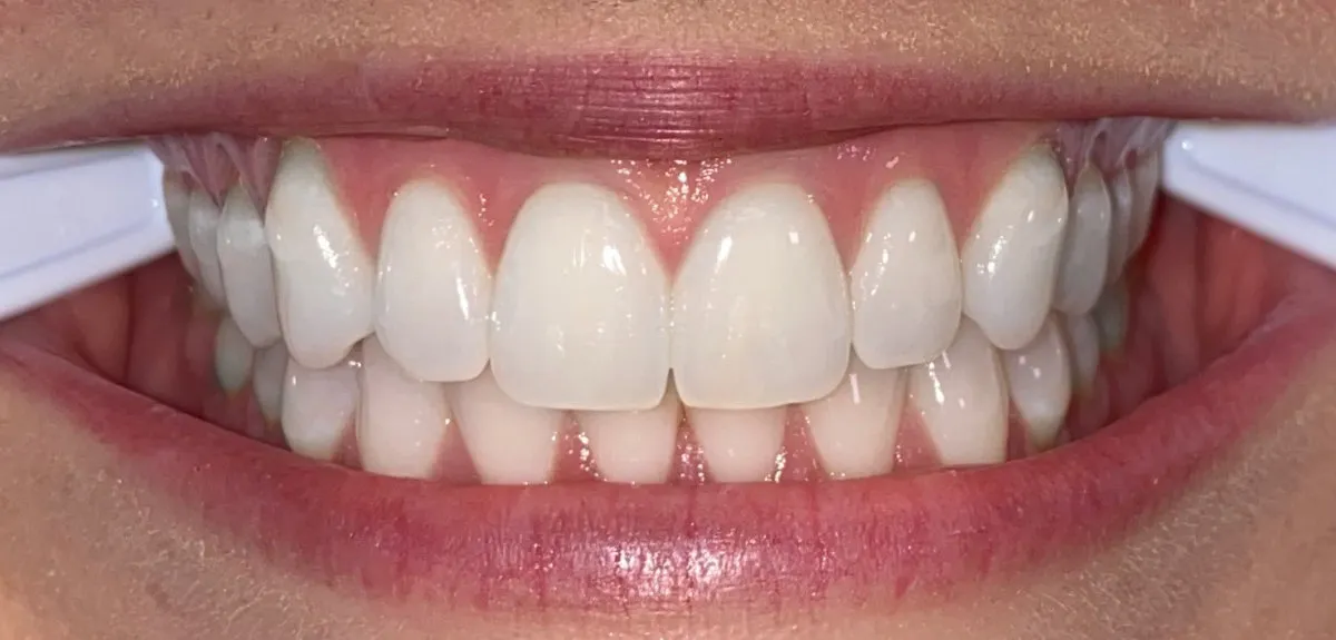 Front view of straight teeth with cheek retractors after orthodontic treatment.