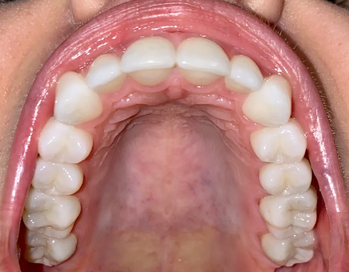 Close-up of a straightened upper arch of teeth after orthodontic treatment.