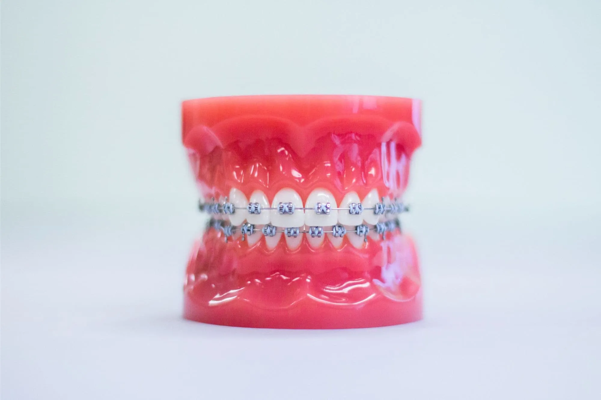 Dental model with metal braces and blue archwire on a white background at Bond Orthodontics in Northbrook IL.