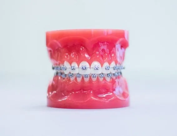 Dental model with metal braces and silver archwire on a white background.