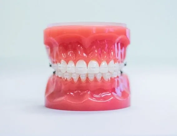 Dental model with clear ceramic braces on a white background.