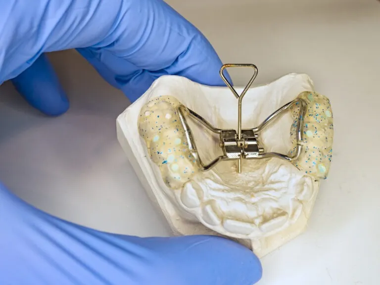 Gloved hand holding a palatal expander appliance on a plaster dental mold.