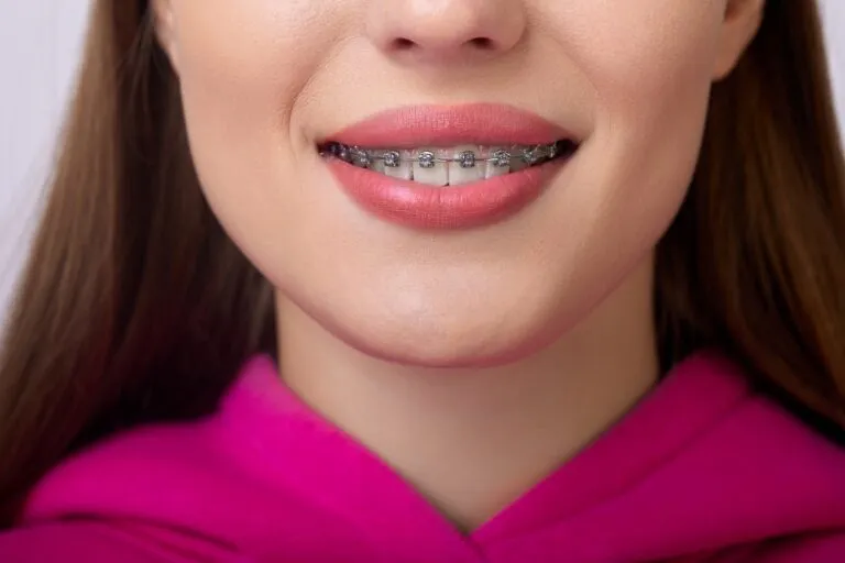 Close-up of a smile with metal braces framed by a pink hoodie.