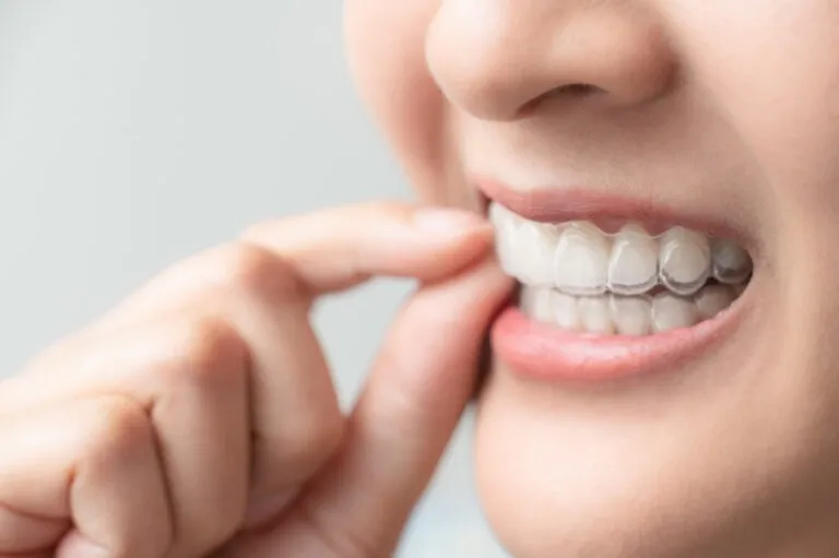 Hand holding a clear aligner in front of a smiling mouth.