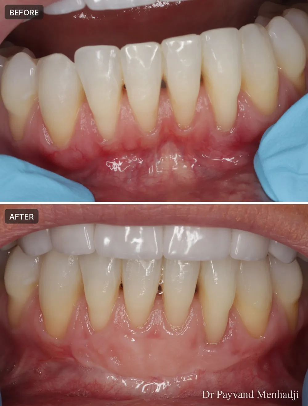 Before and after gum graft on the lower front teeth