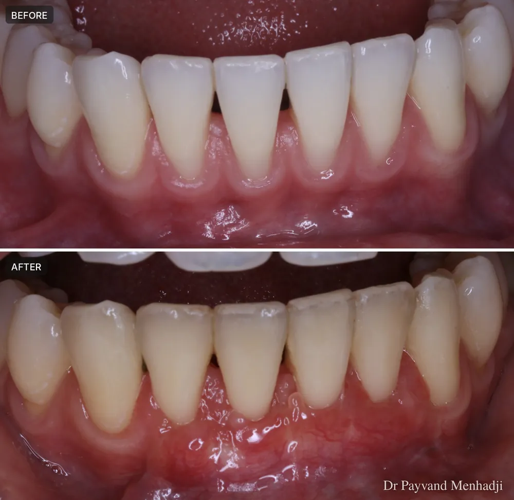 Before and after coverage of multiple recession sites on the lower front teeth