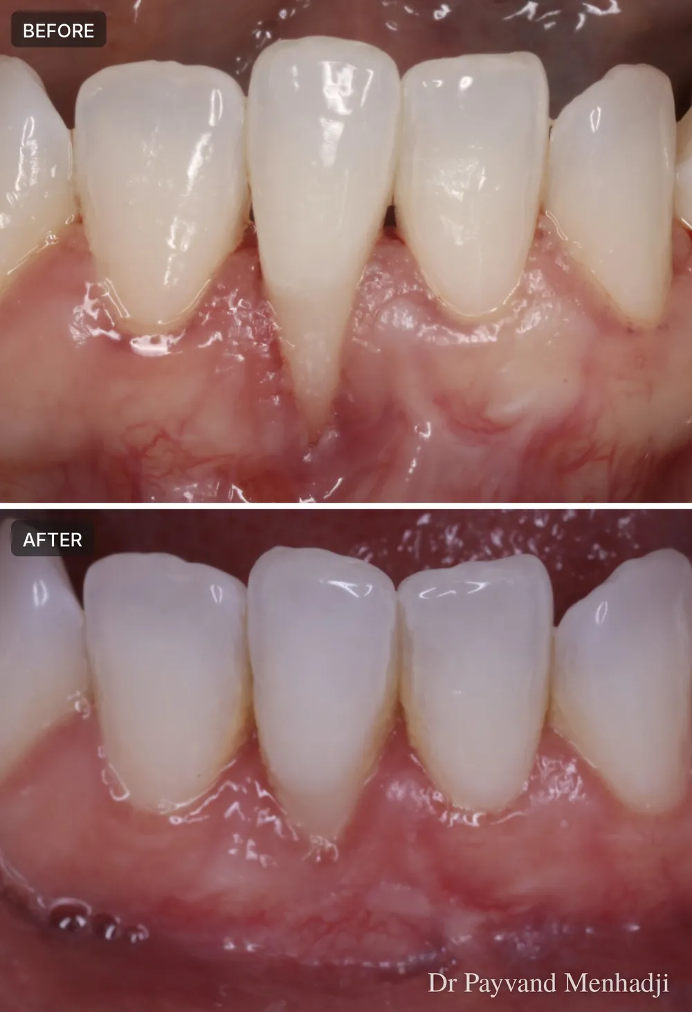 Before and after root coverage on a lower incisor, close-up