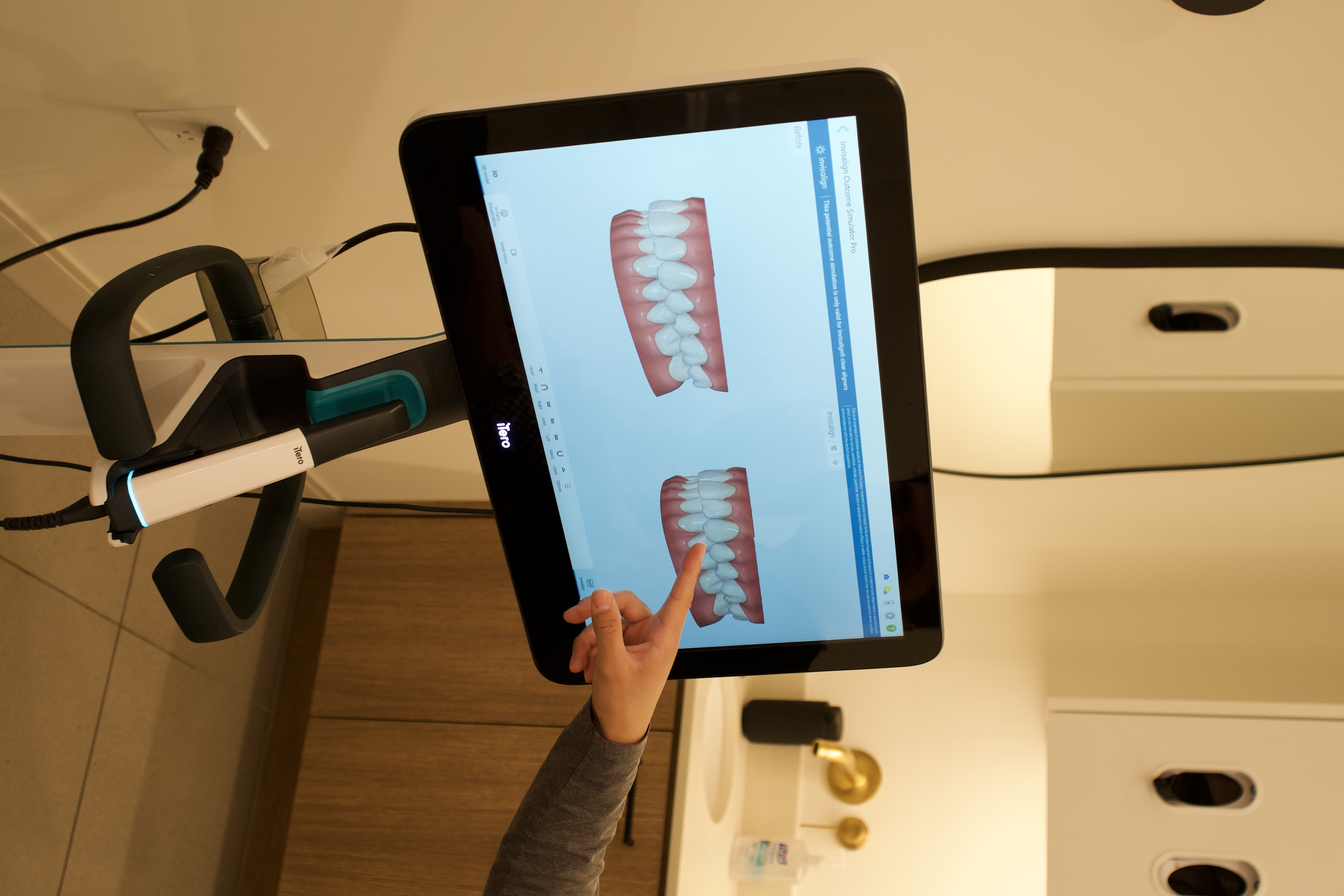 iTero Invisalign outcome simulation used for personalized treatment planning at Springs Dental