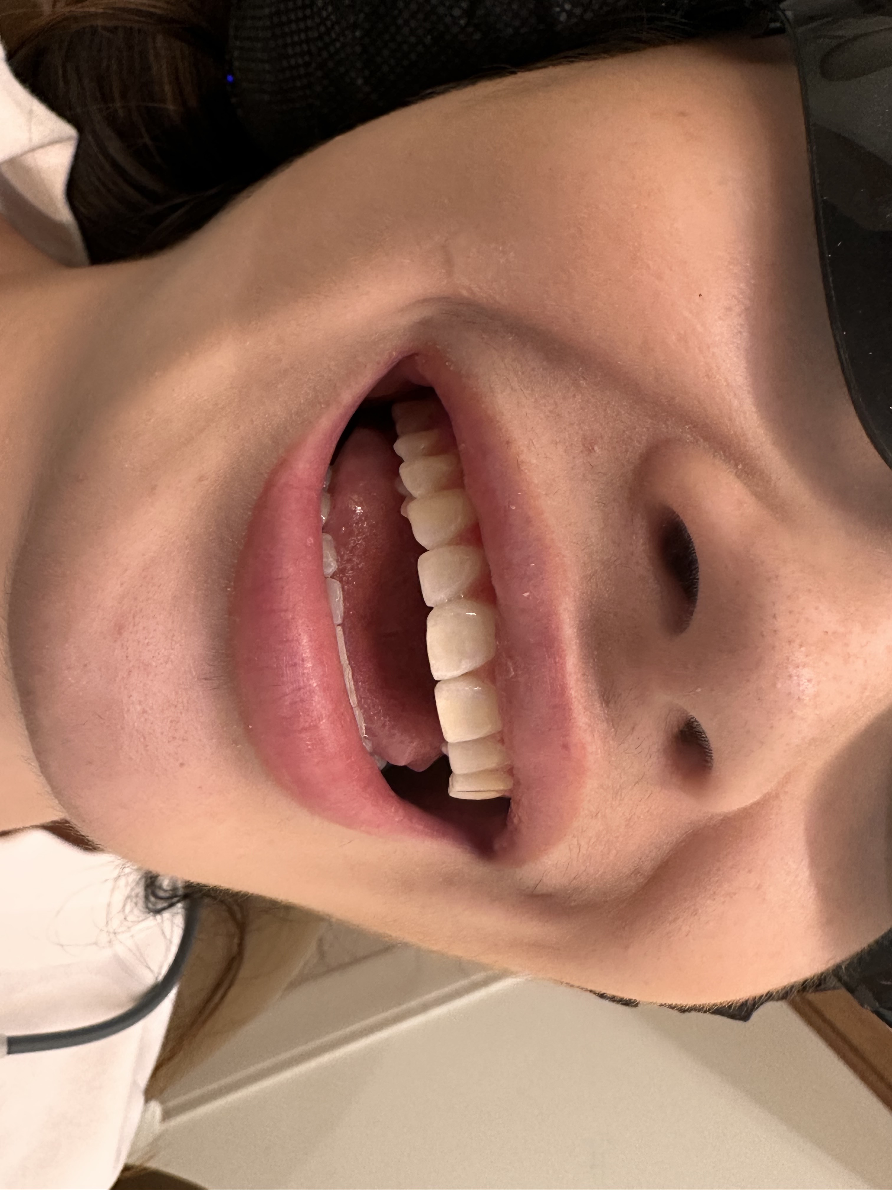 Close-up of a natural smile for veneer treatment at Springs Dental
