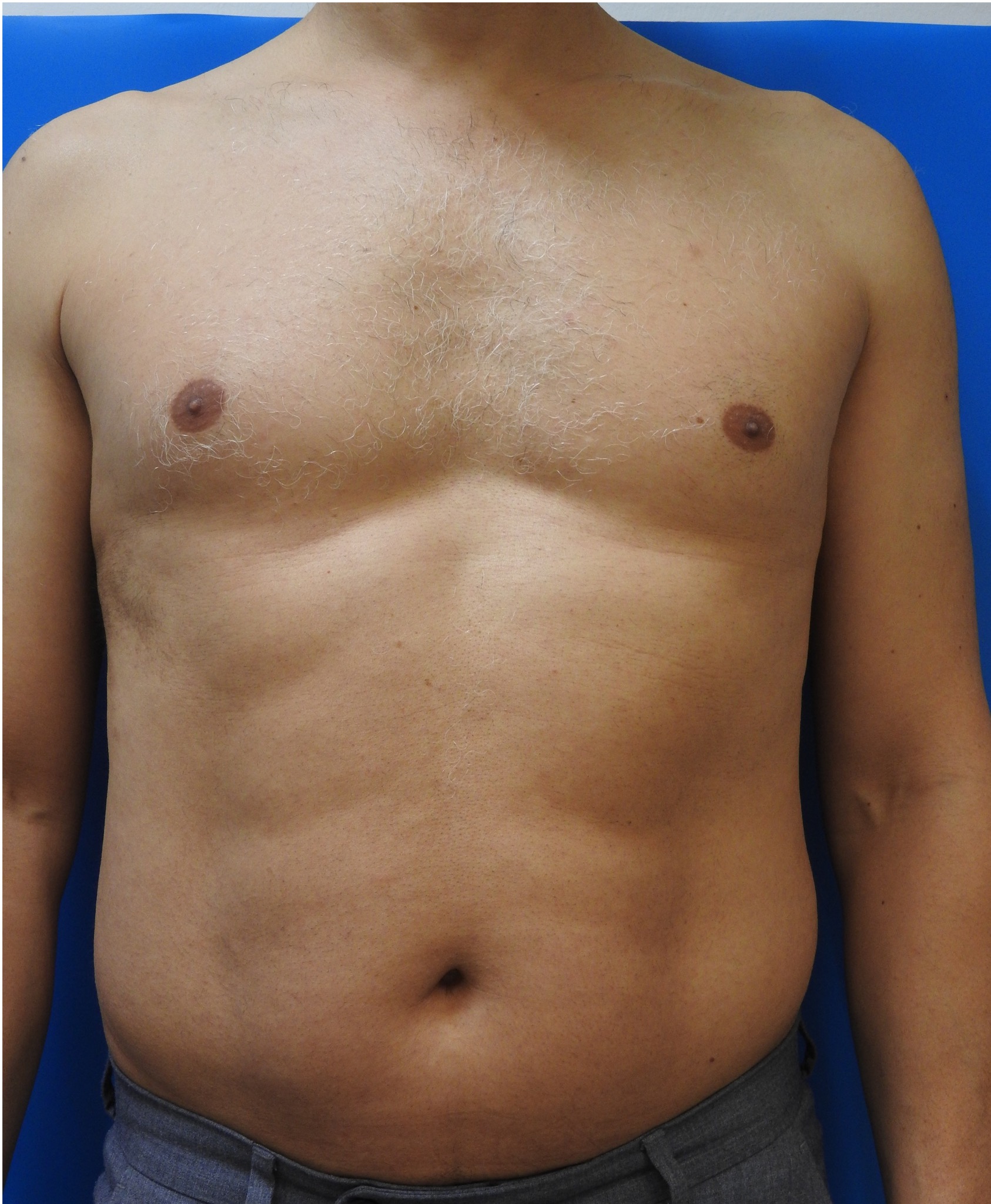 Chest after six sessions
