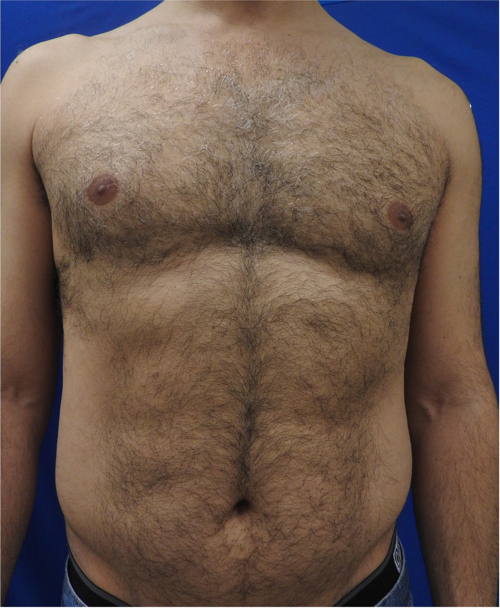 CHEST & STOMACH, before treatment