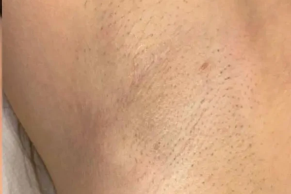Underarm after four sessions