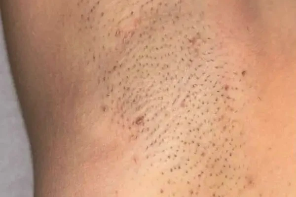 UNDERARMS, before treatment