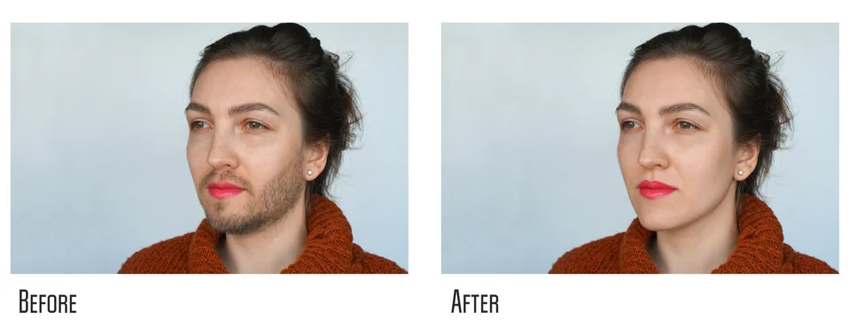 Side-by-side comparison of a person with facial hair before and after laser hair removal treatment.
