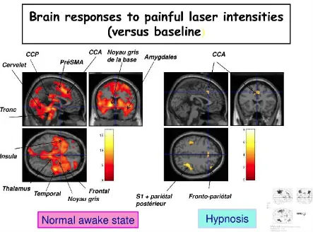 Imagerie cérébrale : réponses du cerveau à la douleur à l'état d'éveil et sous hypnose