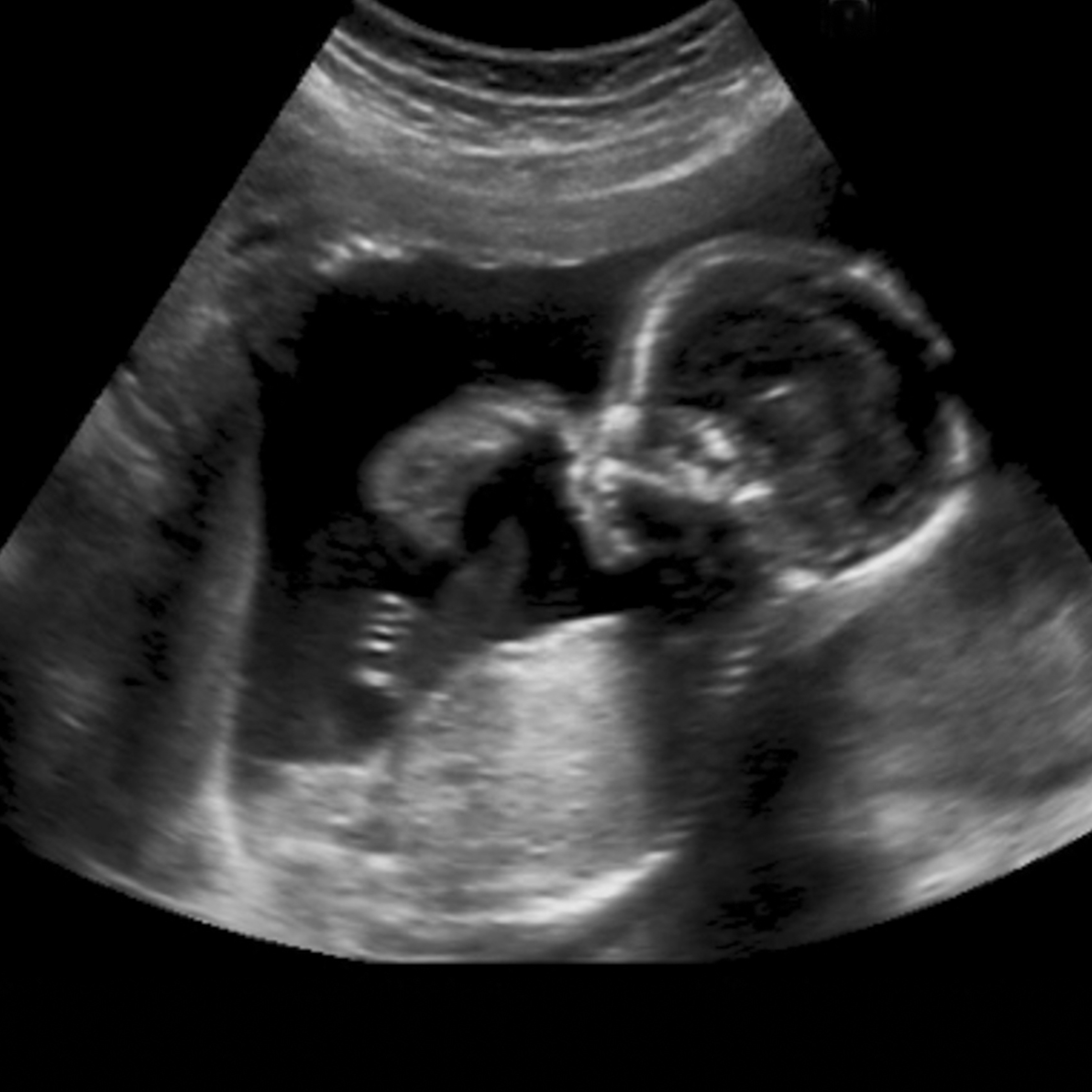 Abortion Procedures