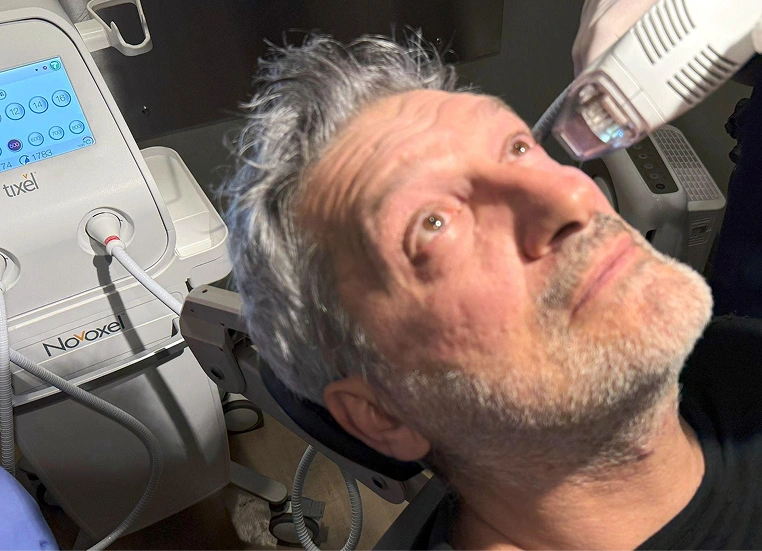 Man with gray hair receiving a thermal skin rejuvenation facial treatment with Novoxel device.