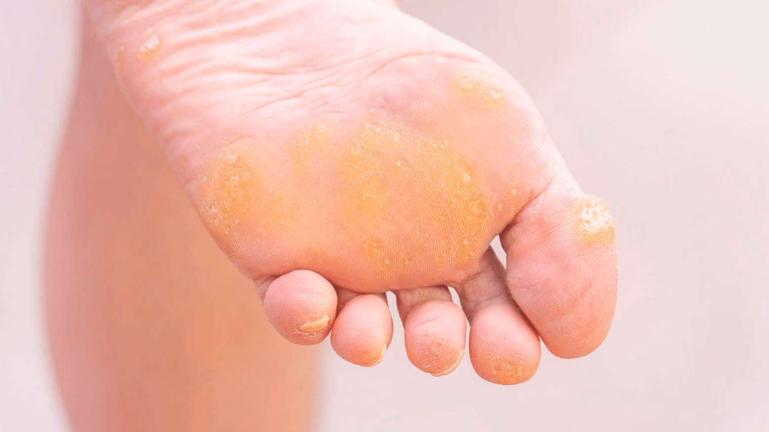 Corns And Callus
