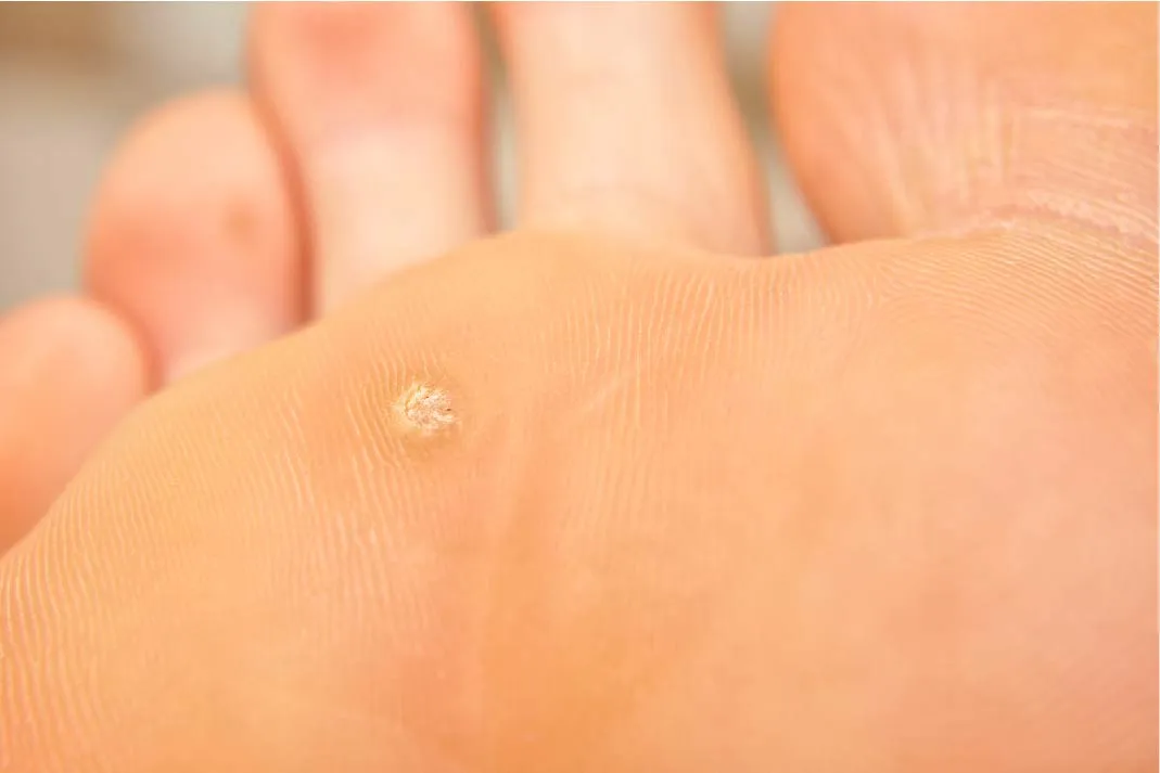 Verruca Treatment