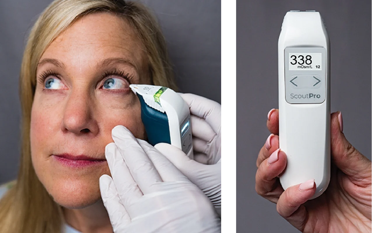 ScoutPro osmolarity pen sampling tears from the lower lid margin to measure tear osmolarity