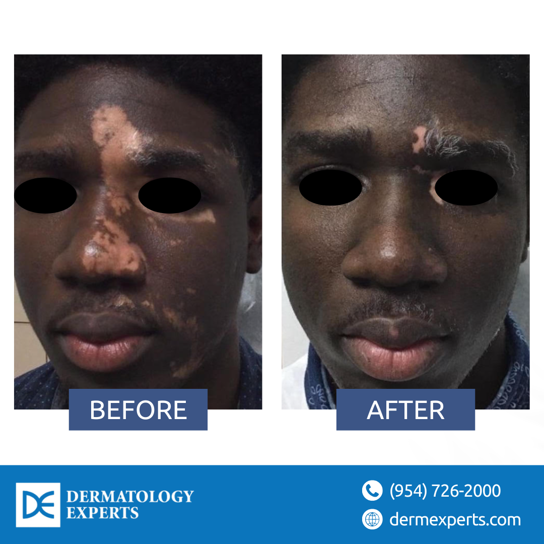 Vitiligo