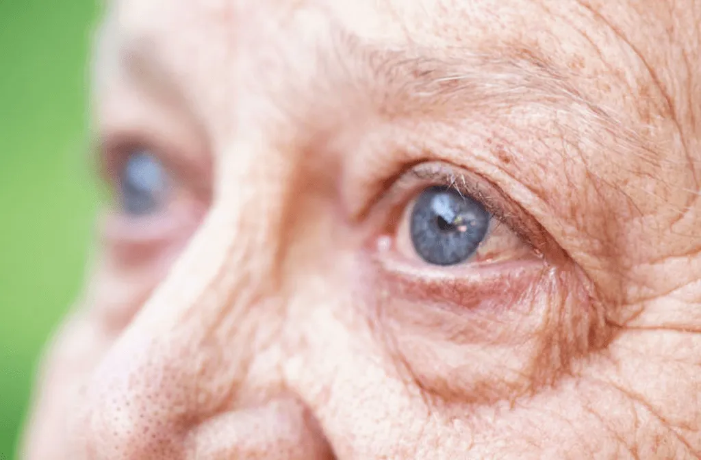 Dry AMD condition illustration