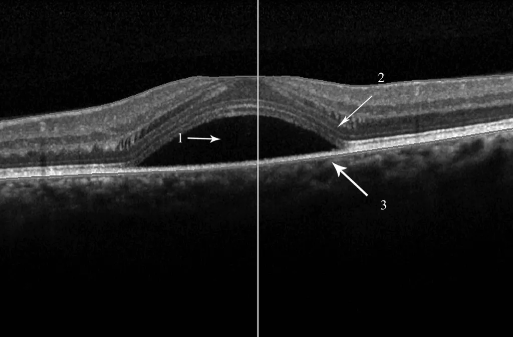 Central serous chorioretinopathy condition illustration