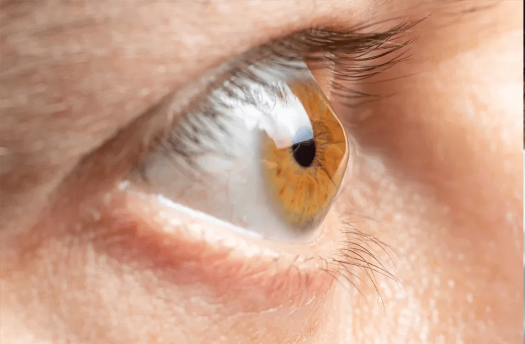 Keratoconus condition illustration