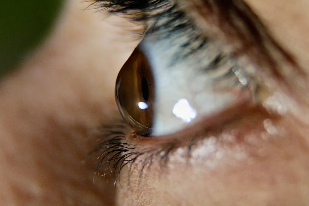 Post-LASIK ectasia condition illustration