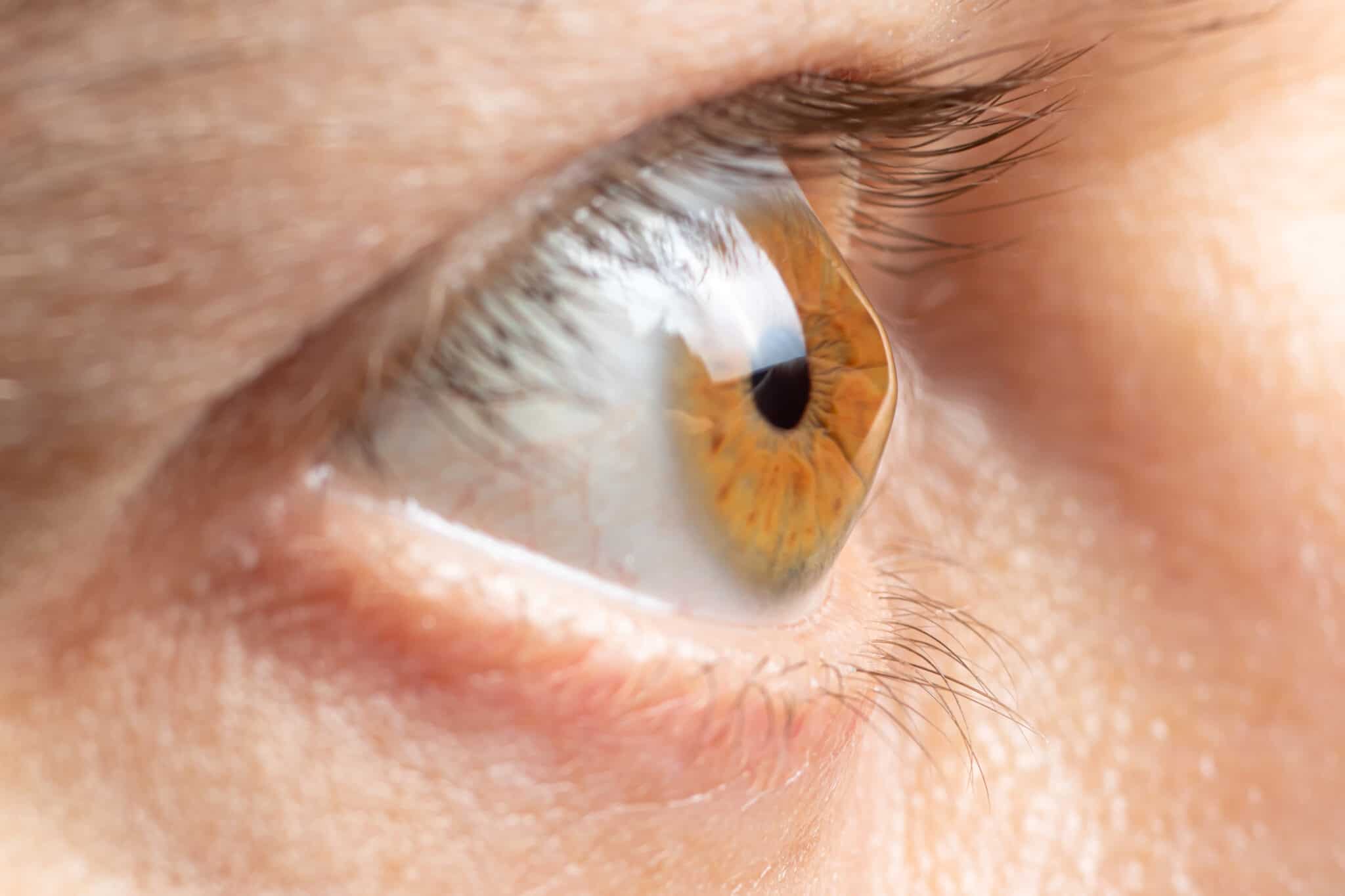 Cone-shaped cornea seen from the side