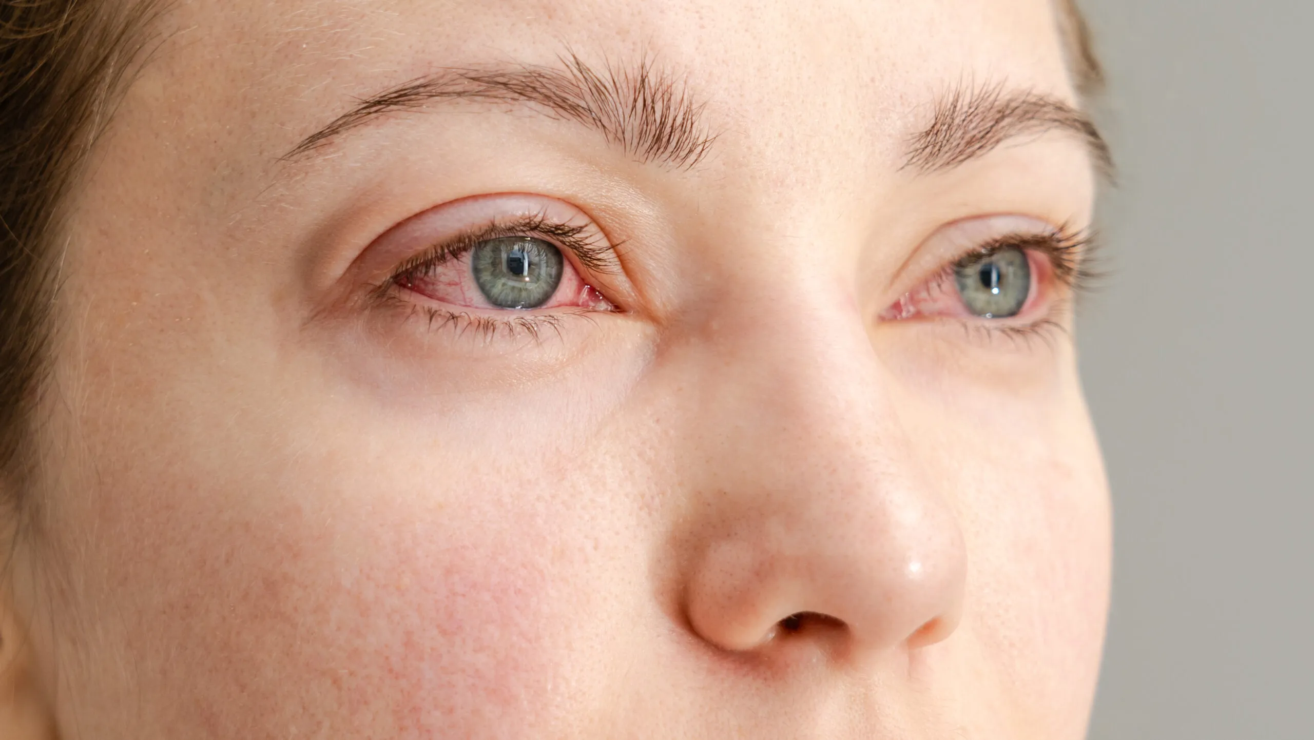 Close view of an inflamed eye