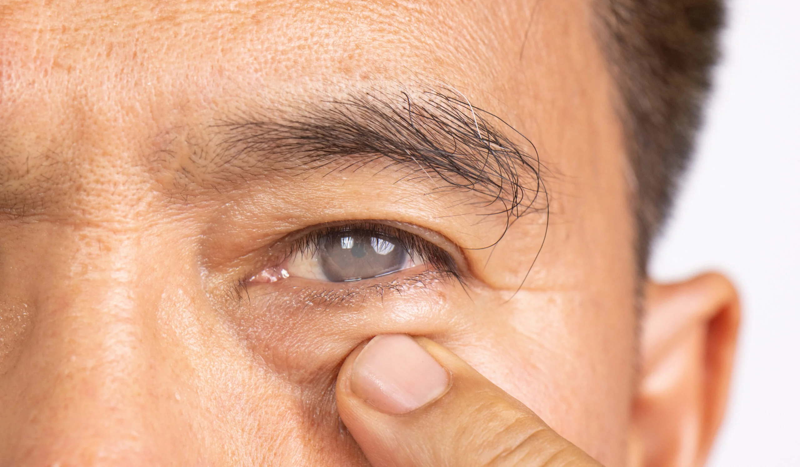 Corneal dystrophy seen up close