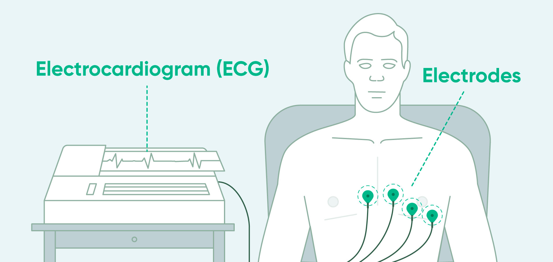 Illustration of an ECG, showing the machine and electrodes placed on the chest