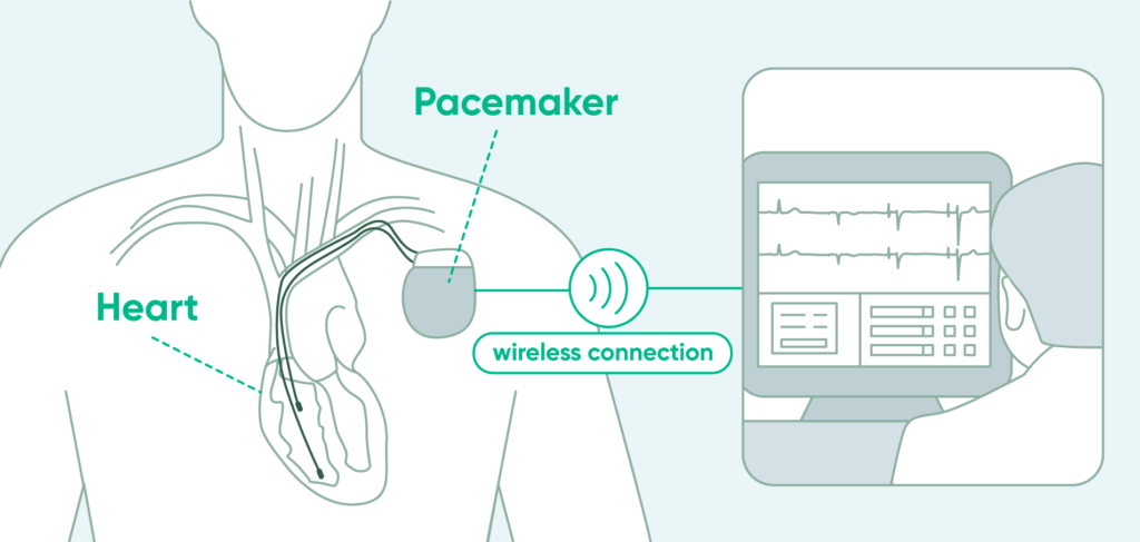 Illustration of a pacemaker check, showing the device in the chest and its wireless connection to the reader